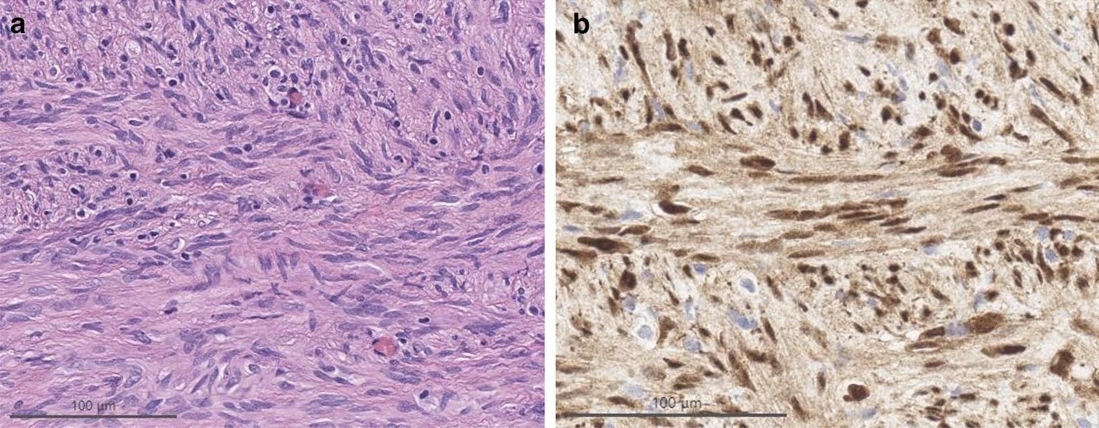 <b>【佳学基因检测】爸爸基因评估分析发现CNN2突变，我需要做检测吗？</b>